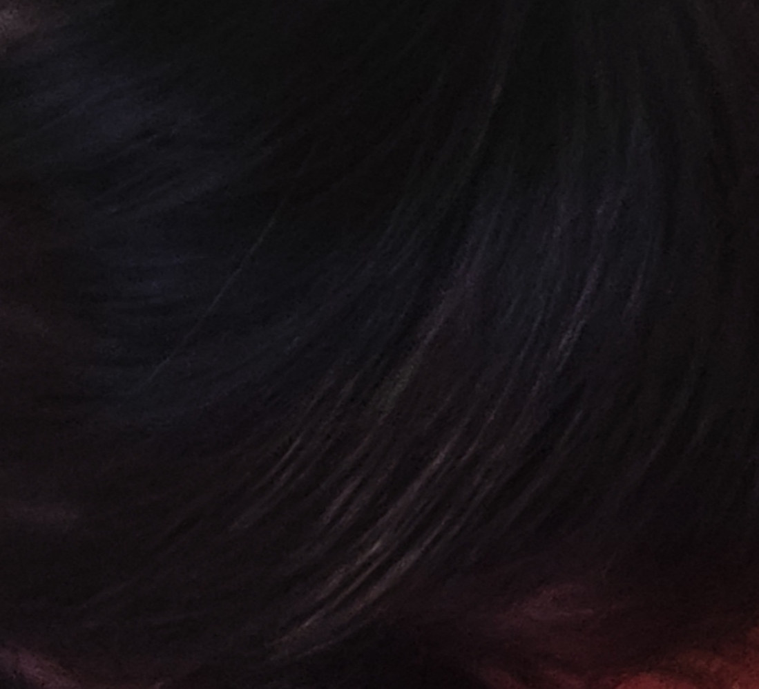 Удаление вросшего волоса | Пикабу