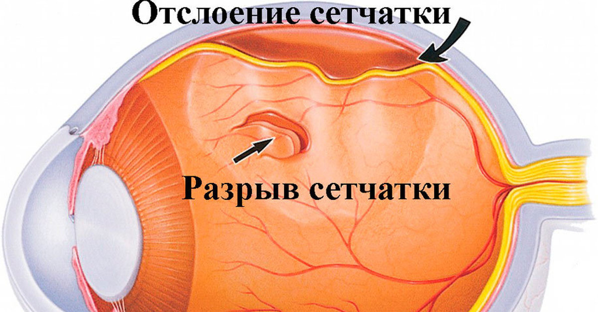 Сетчатка беременности. Неопластическая отслойка сетчатки. Пузыревидная отслойка сетчатки. Тракционная отслойка сетчатки глаза. Отслойка сетчатки флуоресцеин.
