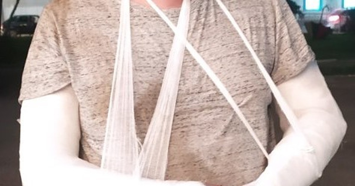 девочка сломала обе руки. перелом обеих рук. перелом обеих рук. девочка сломала обе руки. перелом обеих рук.