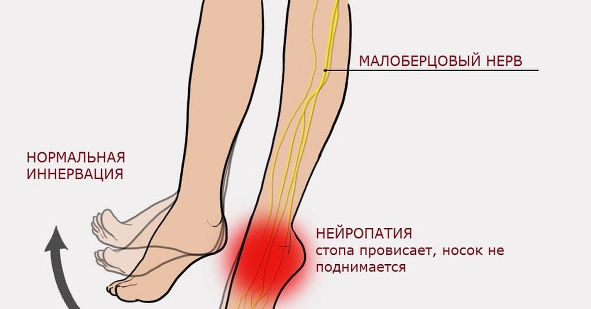 Защемляет ступню