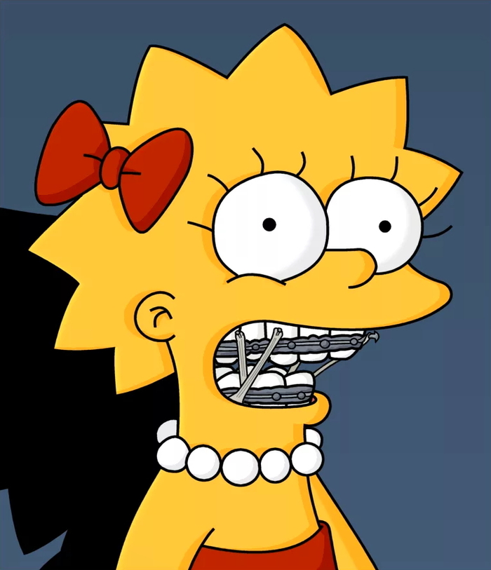 Поставил БРЕКЕТЫ (сколько стоит?!)