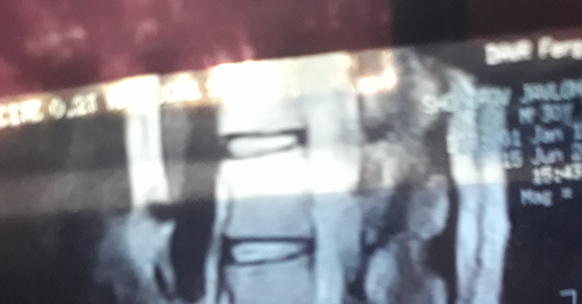 Грыжа в поясничном отделе позвоночника | Пикабу