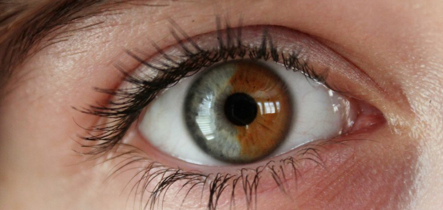 Как называется болезнь когда разный цвет глаз. Центральная гетерохромия радужной оболочки. Секторная гетерохромия глаза у человека. Центральная гетерохромия хамелеон. Гетерохромия карих глаз.