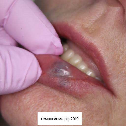 Удаление гемангиомы губы