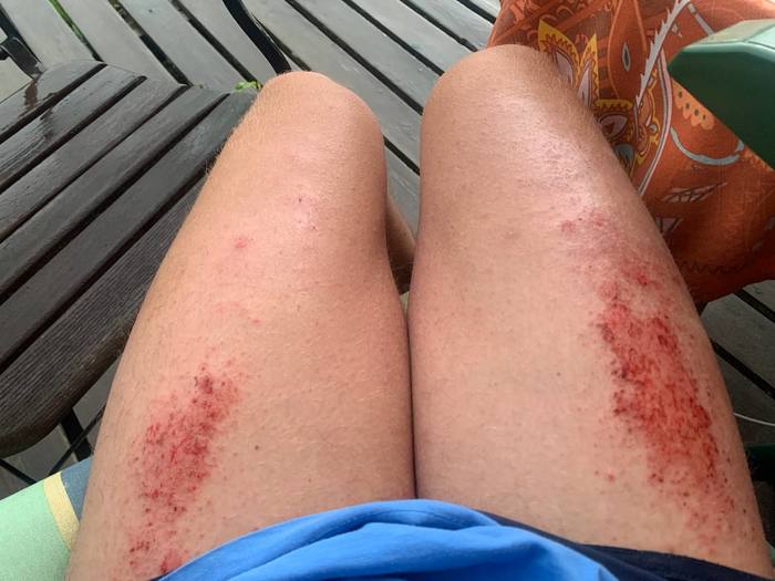 Атопический нейродермит (дерматит)