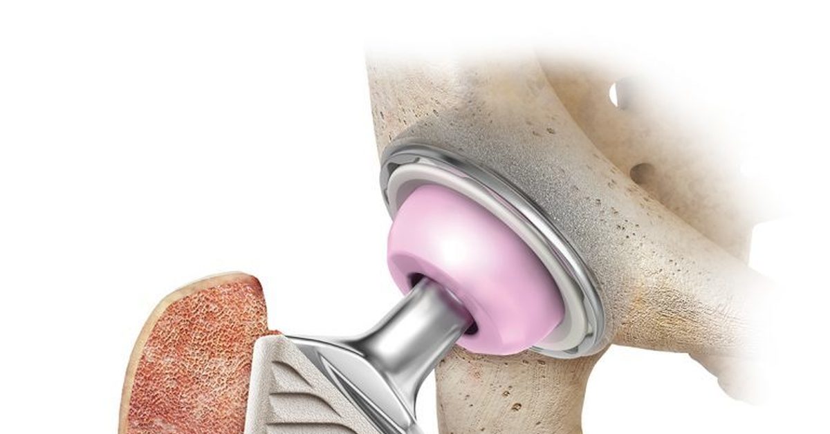 Эндопротез тазобедренного сустава отзывы. Тазобедренный эндопротез Stryker. Эндопротез тазобедренного сустава Страйкер. Коленный модульный эндопротез Stryker. Wright Infinity эндопротез.