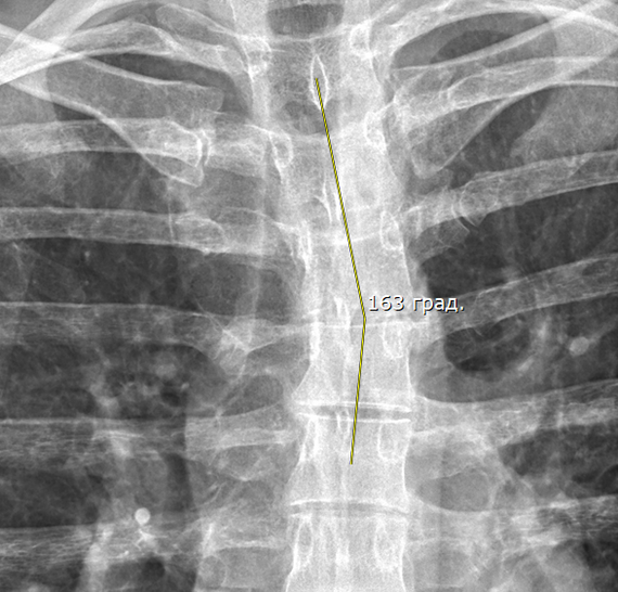 Сколиоз 17 градусов фото. Угол искривления позвоночника более 17 градусов фото.