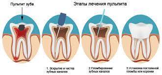 Пульпит зуба: что это такое и как лечить? Симптомы и профилкатика