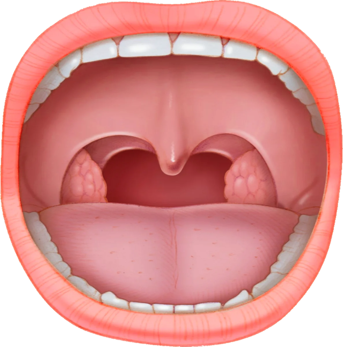Открытая полость рта. Тонзиллит паратонзиллярный абсцесс. Ангина паратонзиллярный абсцесс. Ратонзиллярный абсцесс”.. Тонзиллит ротовая полость.