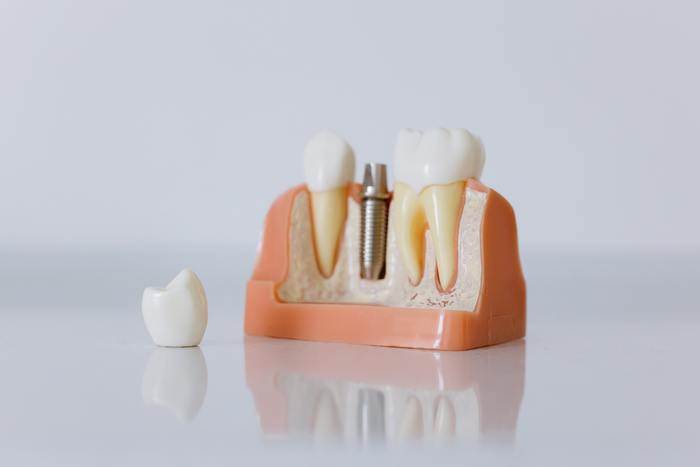 Зубной имплант... Как выглядит? Стоматология, Импланты, Имплантация зубов, Зубные протезы