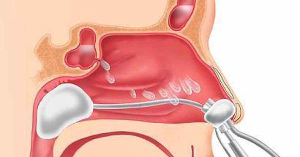 Полип в гайморовой пазухе. Верхнечелюстной синусит пункция. Пункция гайморовой пазухи операция. Баллонная синусопластика. Канюля для промывания гайморовой пазухи.