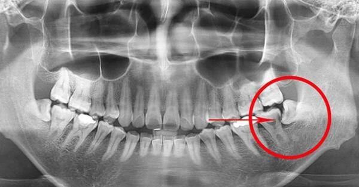 Фото Удаленных Зубов Мудрости