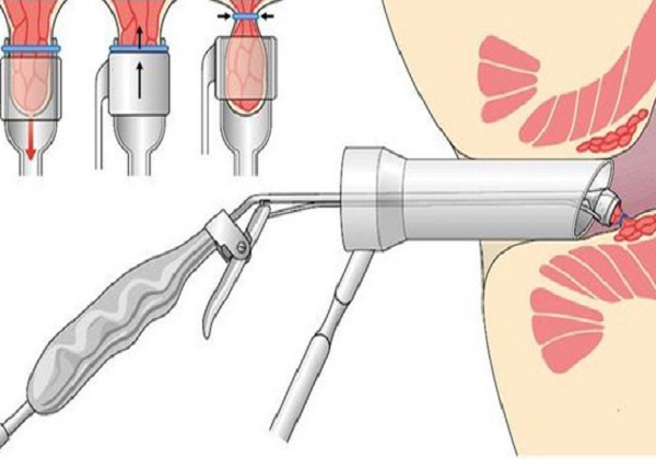 Лигирование геморроя латексными кольцами фото