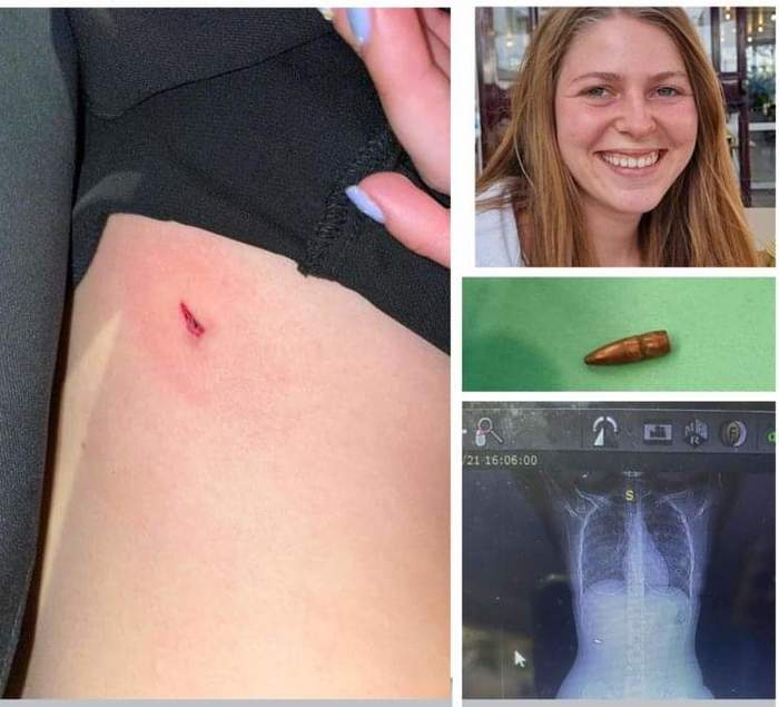 Девушка в течение трёх месяцев не знала, что у нее в груди пуля