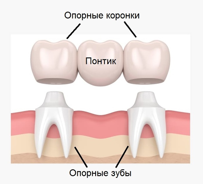 Мост или имплант