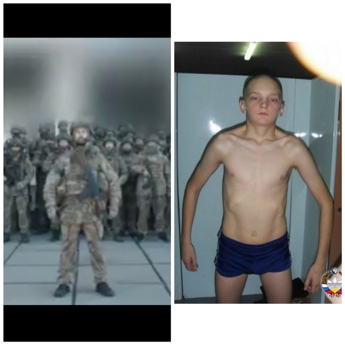 Синдром широкой спины