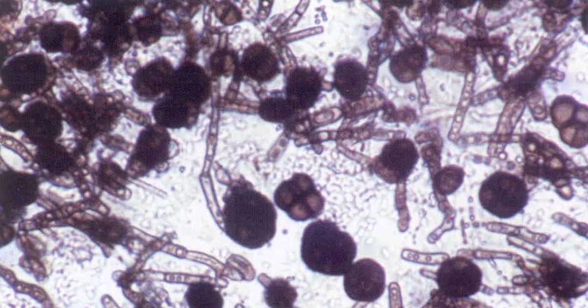 На коже обнаружены споры. Кандида грибок микроскопия. Микроскопия грибковых заболеваний. Микоз кожи микроскопия.