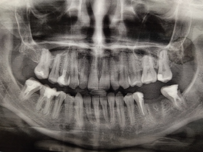 Про зубы, точнее про их отсутствие Зубы, Стоматология, Совет, Нужен совет