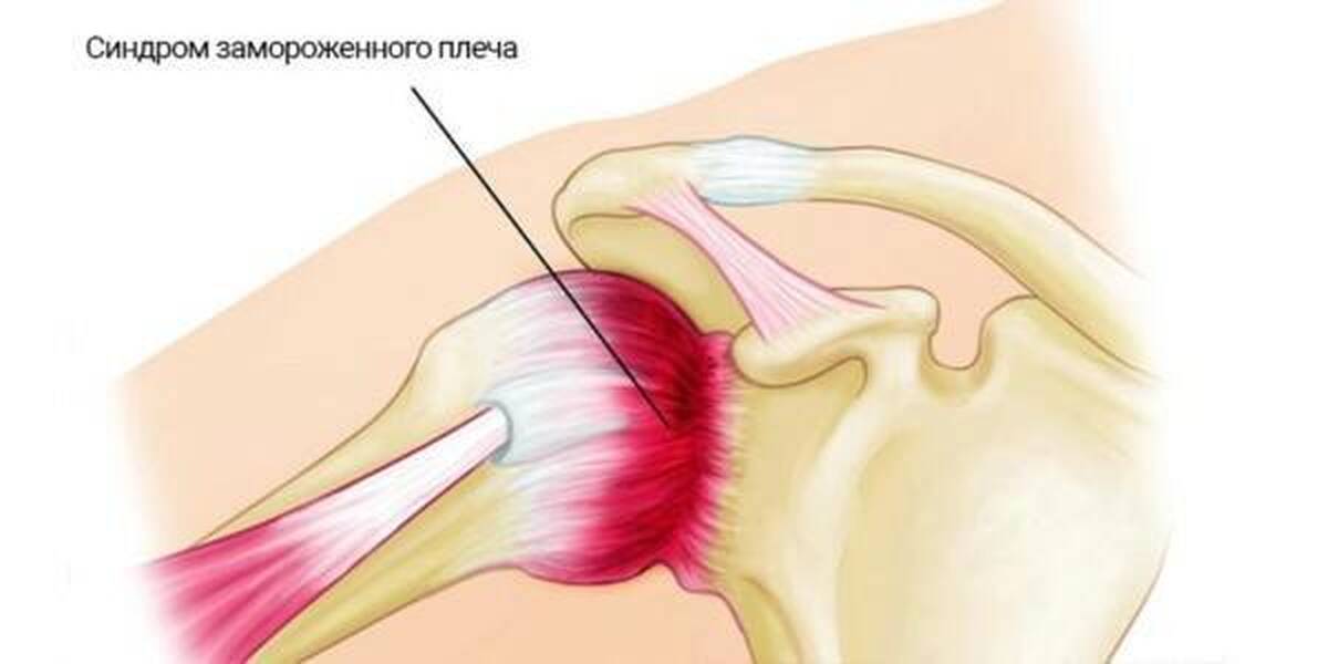 Капсулит. Периартрит плечевого сустава. Синдром плечелопаточный периартрит. Ретрактильный капсулит. Периартериит плечевого сустава.