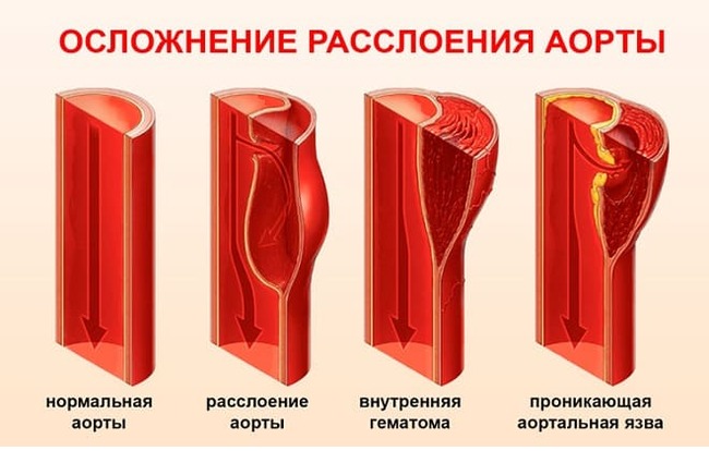 Расслоение аорты | Пикабу