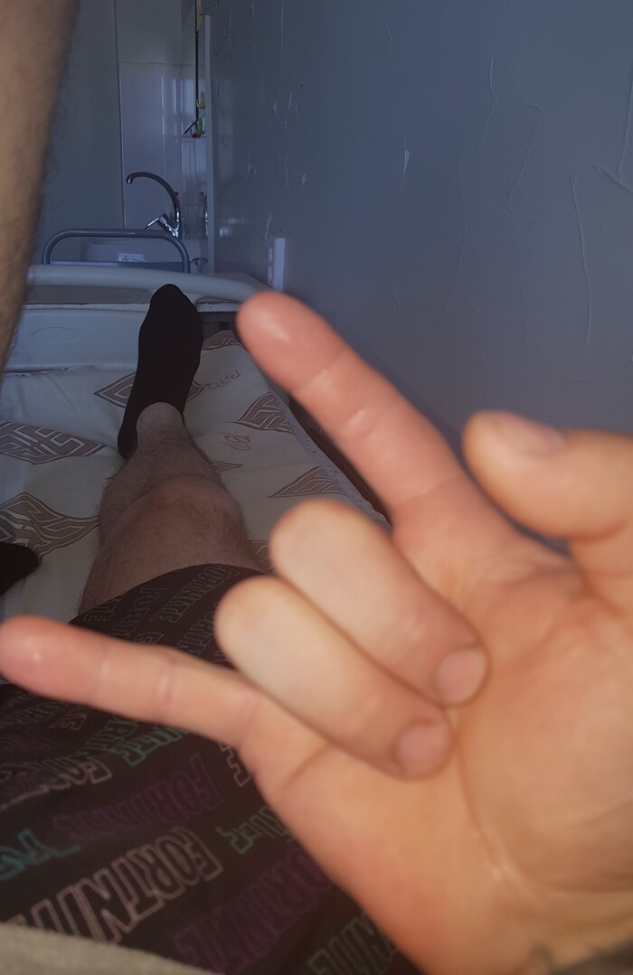 Щелкающий палец (стенозирующий лигаментит). Болезнь Нотта. Личный опыт лечения