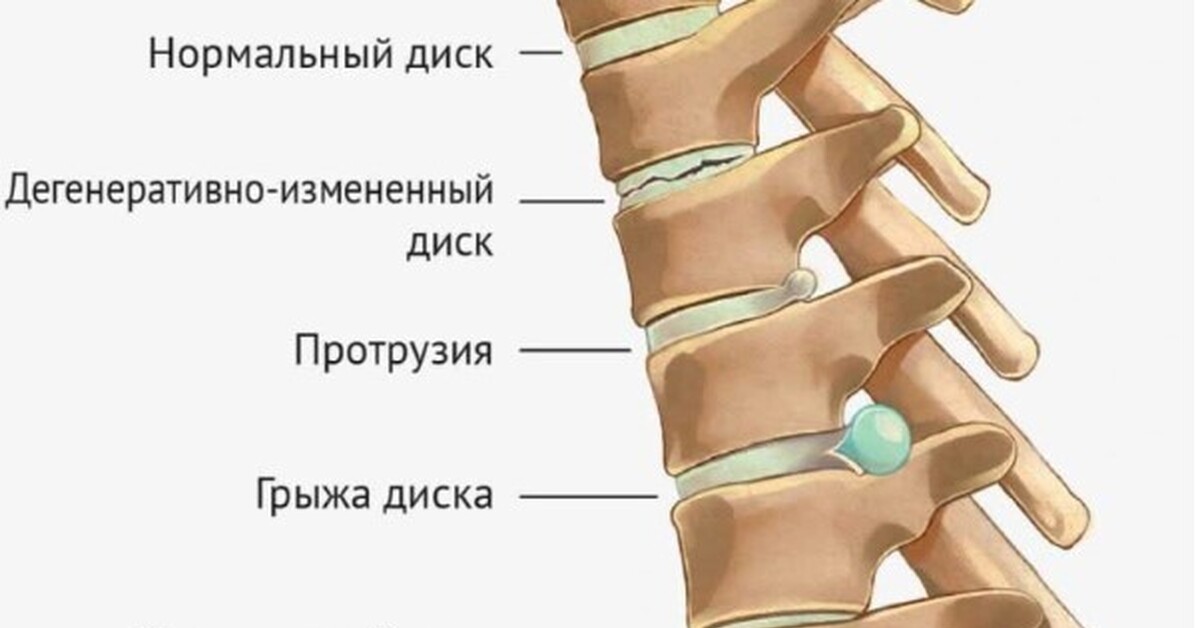 Румалон грыжа позвоночника. Остеохондроз протрузии и грыжи позвоночника. Протрузия экструзия грыжа. Протрузия l5 l6. Протрузия грыжа межпозвонковых дисков.