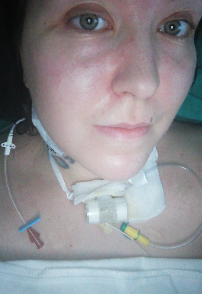 Внезапный стеноз гортани