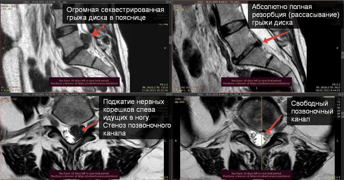 Резорбция грыжи. Грыжа межпозвоночного диска. Междисковая грыжа позвоночника. Грыжа межпозвоночного диска рентген.