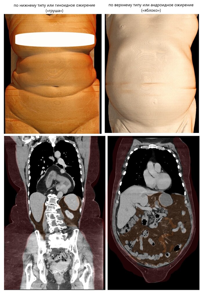 Наглядно об ожирении: "груша" и "яблоко". КТ-примеры