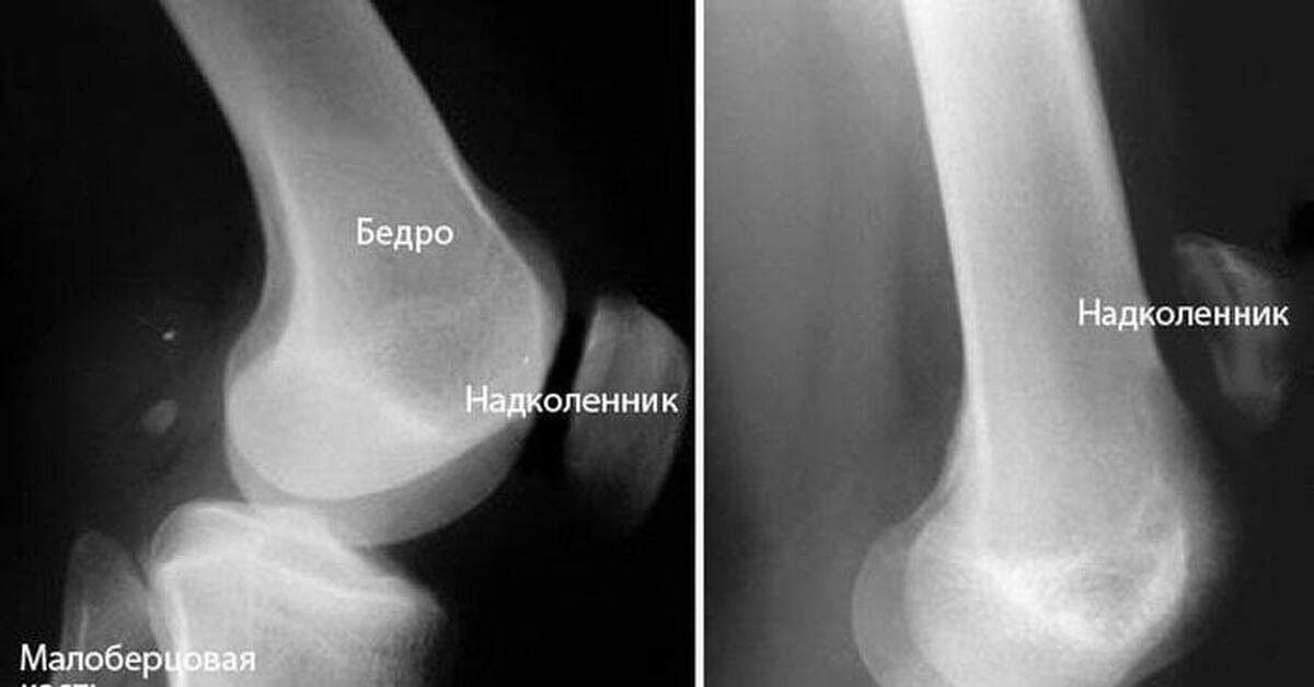 Смещение коленного сустава. Разрыв связки надколенника рентген. Разрыв собственной связки надколенника рентген. Вывих надколенника рентген. Повреждение связок надколенника рентген.