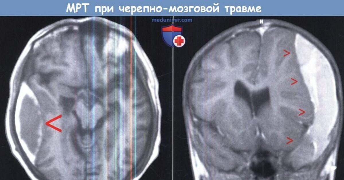 Сотрясение мозга рентген покажет. Мрт при черепно-мозговой травме. Черепно мозговая травма мрт. Черепно мозговая травма кт и мрт.