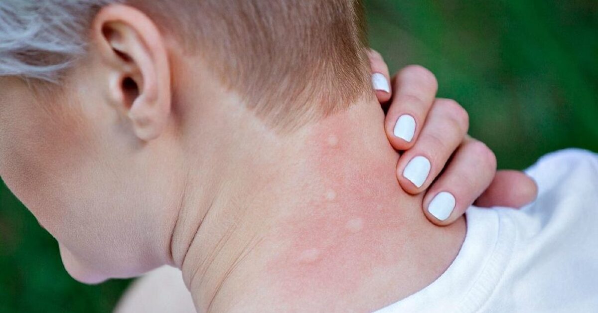 Аллергия на бижутерию
