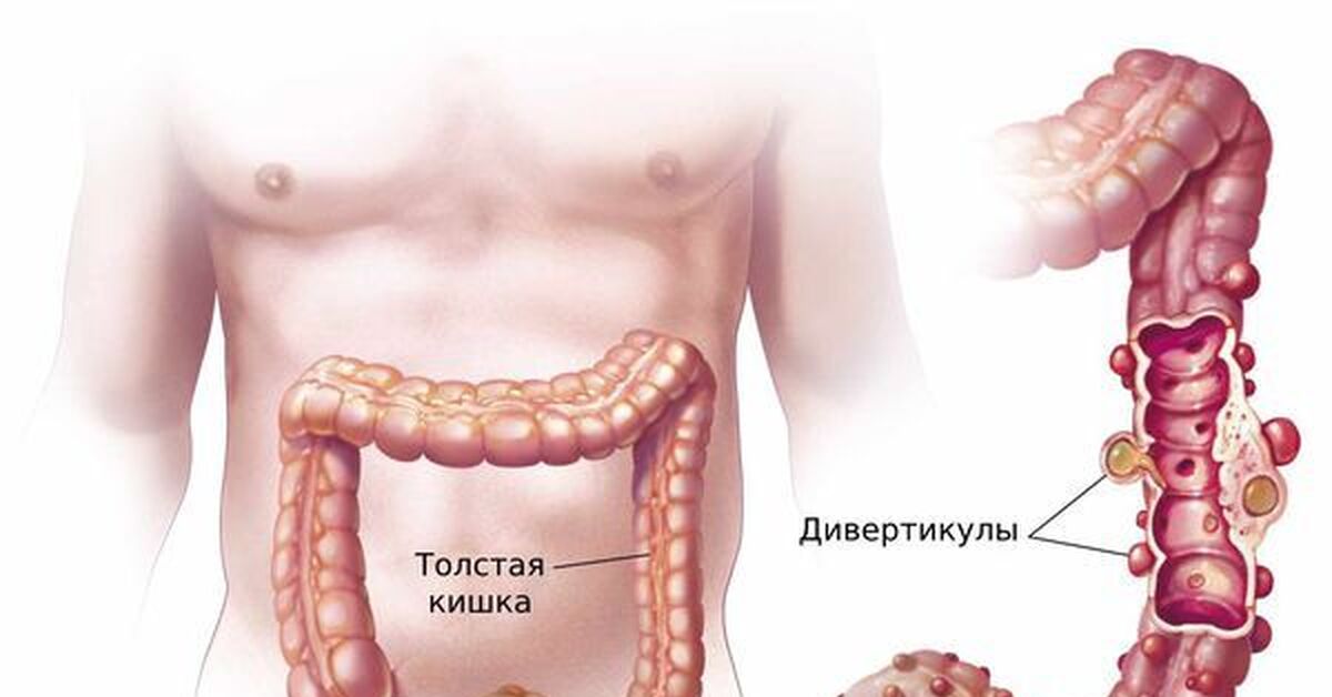 Дивертикулез толстого кишечника что это