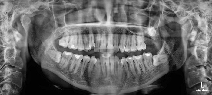 Кривые зубы Зубы, Удаление зубов, Стоматология