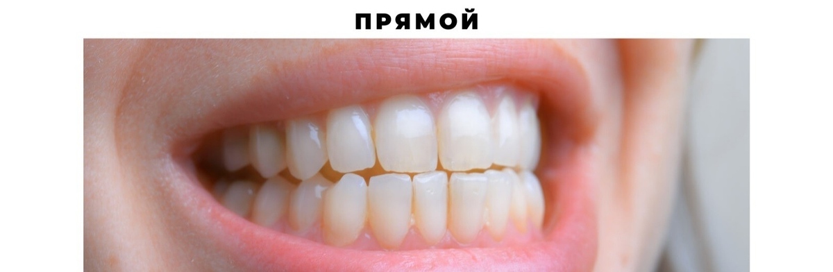 Correct bite