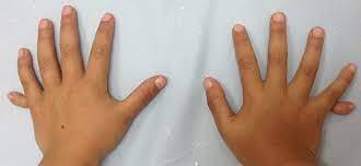 Врожденная полидактилия кисти