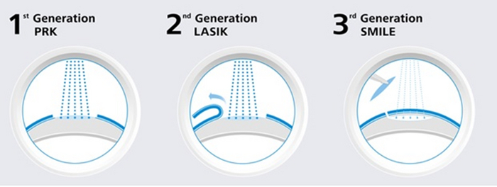    Lasik/.   .   () , ,  ,   , , LASIK, 