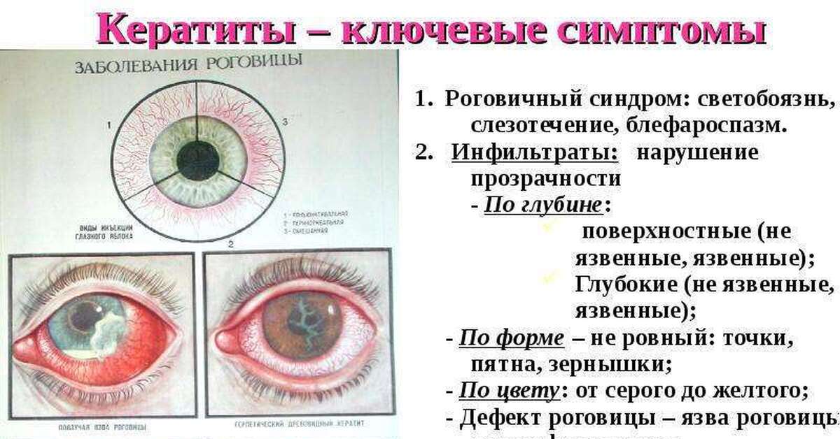 Назовите причины конъюнктивита какую помощь надо оказать. Глазное заболевание кератит. Кератит (воспалительный процесс в роговице глаза)..