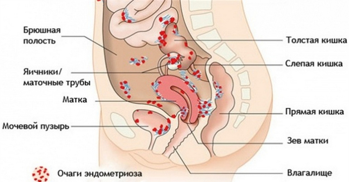 Расположение матки и мочевого пузыря. Строение кишечника и матки. Наружный эндометриоз в брюшной полости.