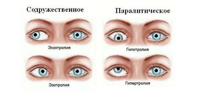 Можно ли исправить косоглазие у взрослых