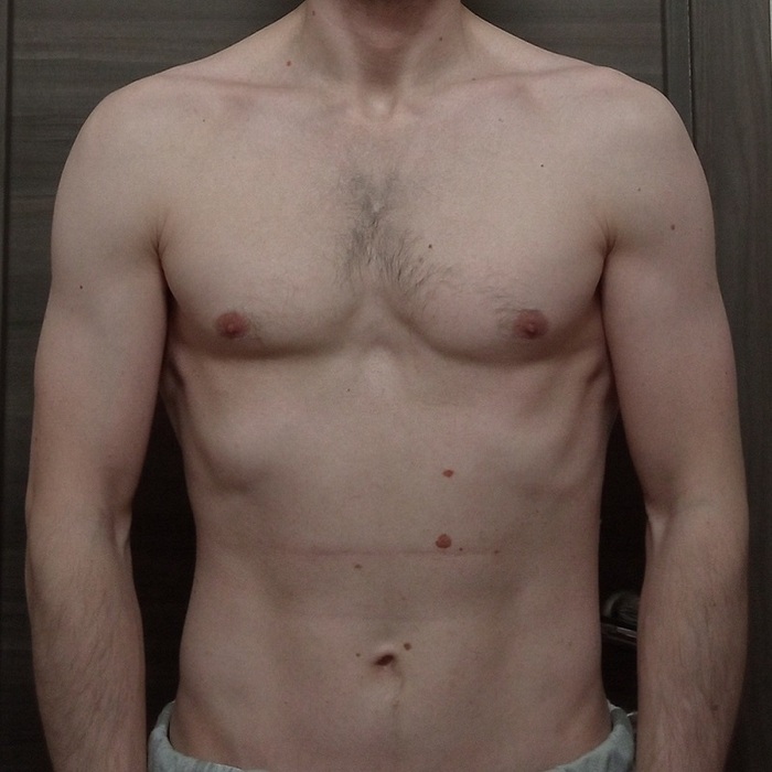 Асимметрия мыщц