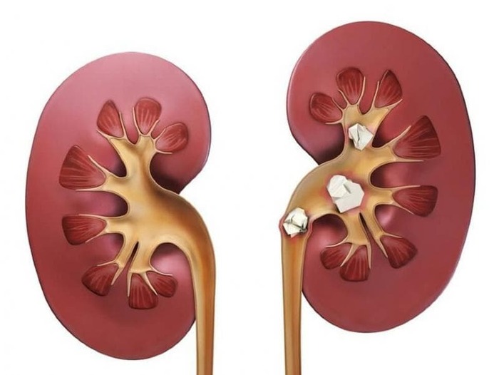 Как определить почечную колику. Мой собственный опыт