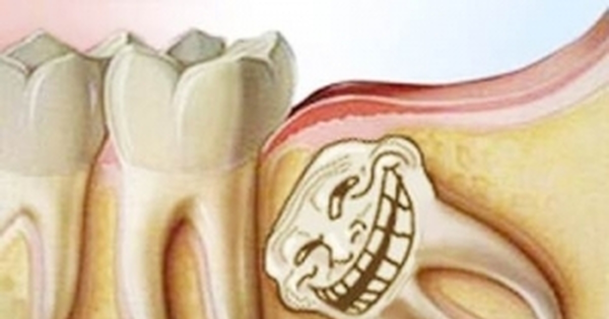 Фото Ретинированных Зубов Мудрости