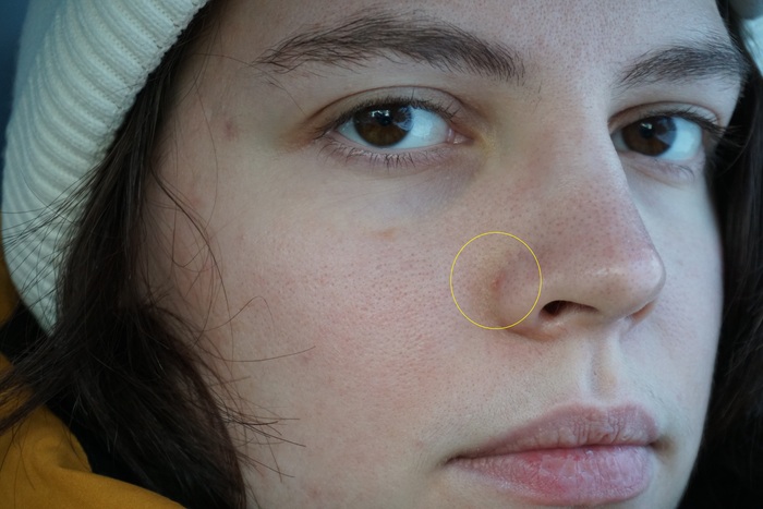 Удаление родинки на лице лазером