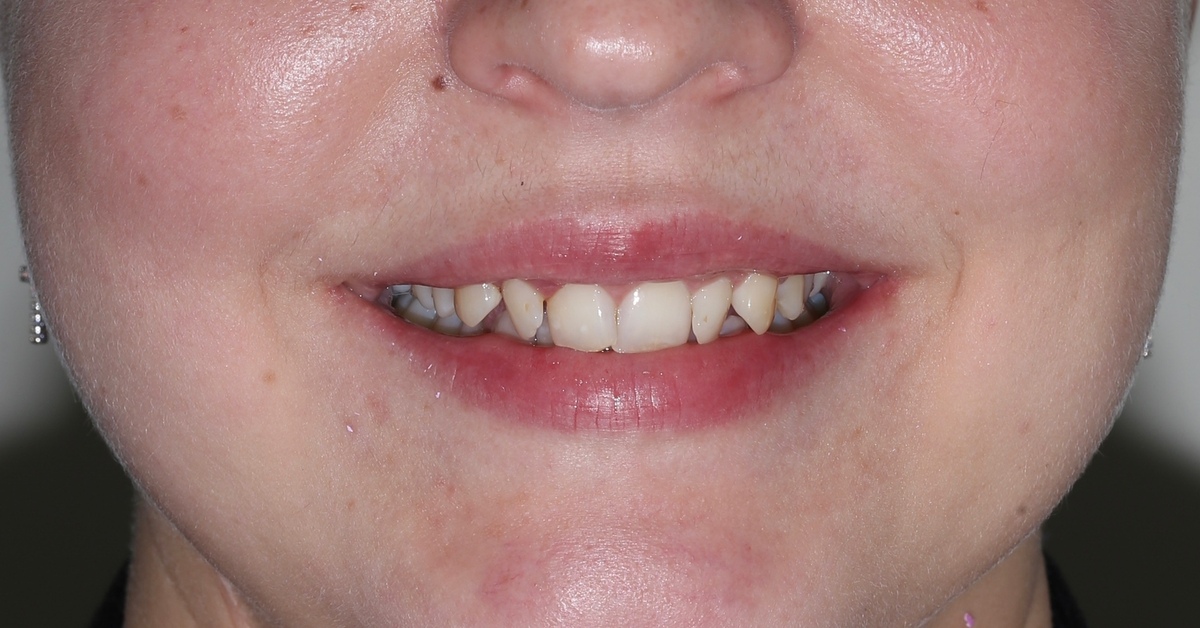 Виниры. Мой опыт | Пикабу