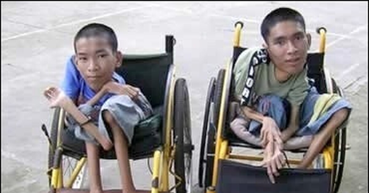 Инвалид дцп. Страшные дети с инвалидностью. Инвалиды дауны. Инвалид дцп. Инвалид 2 группы дцп.