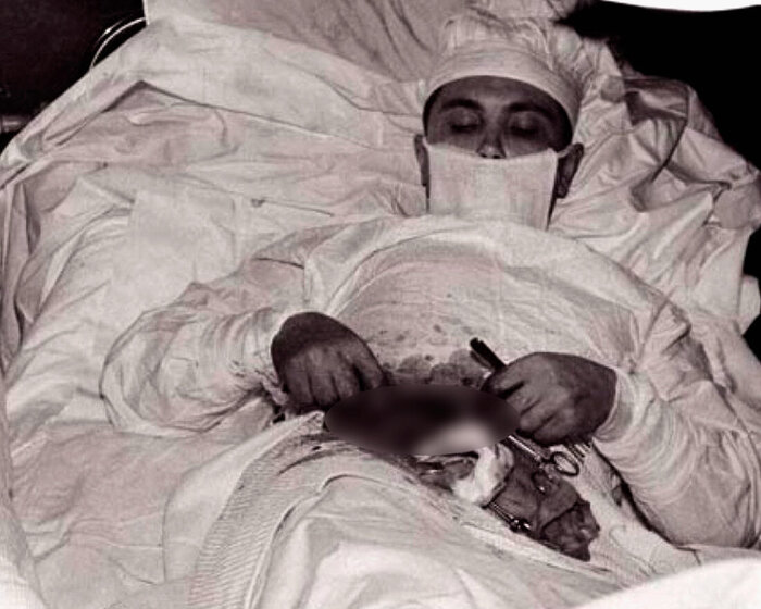 Экстремальная самооперация Рогозова