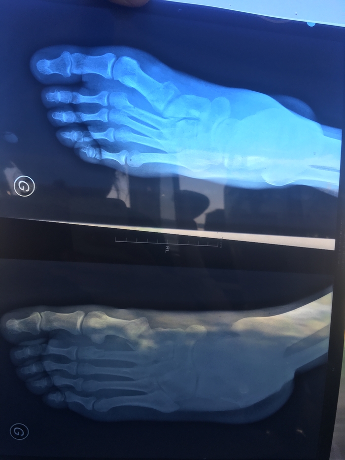 Это перелом или как? | Пикабу