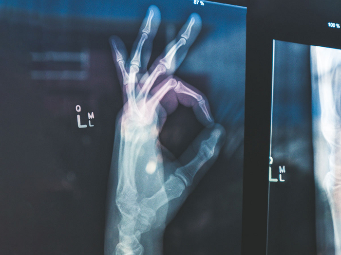 Существуют «неуязвимые» люди со сверхплотными костями