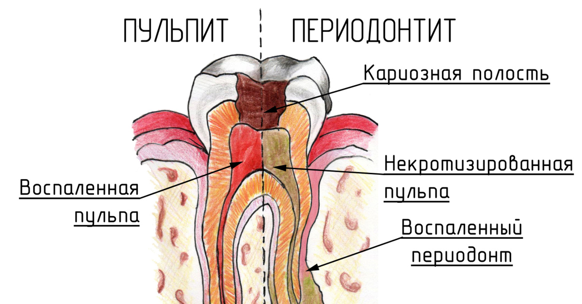 Осложнения периодонтита зуба. Этапы пульпита периодонтит. Классификация кариес пульпит периодонтит. Строение зуба кариес пульпит. Причины развития пульпита и периодонтита.